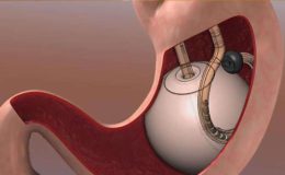 Tüp mide ameliyatı olanlar dikkat: Sıvı alımının önemi